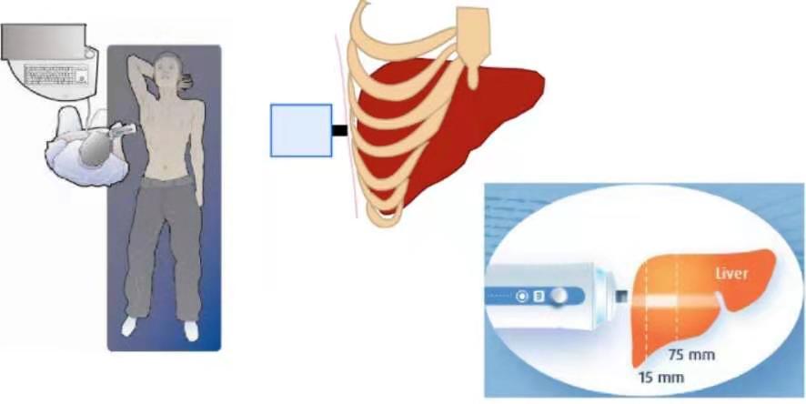 我院引进无创肝脏弹性及脂肪肝定量检测技术