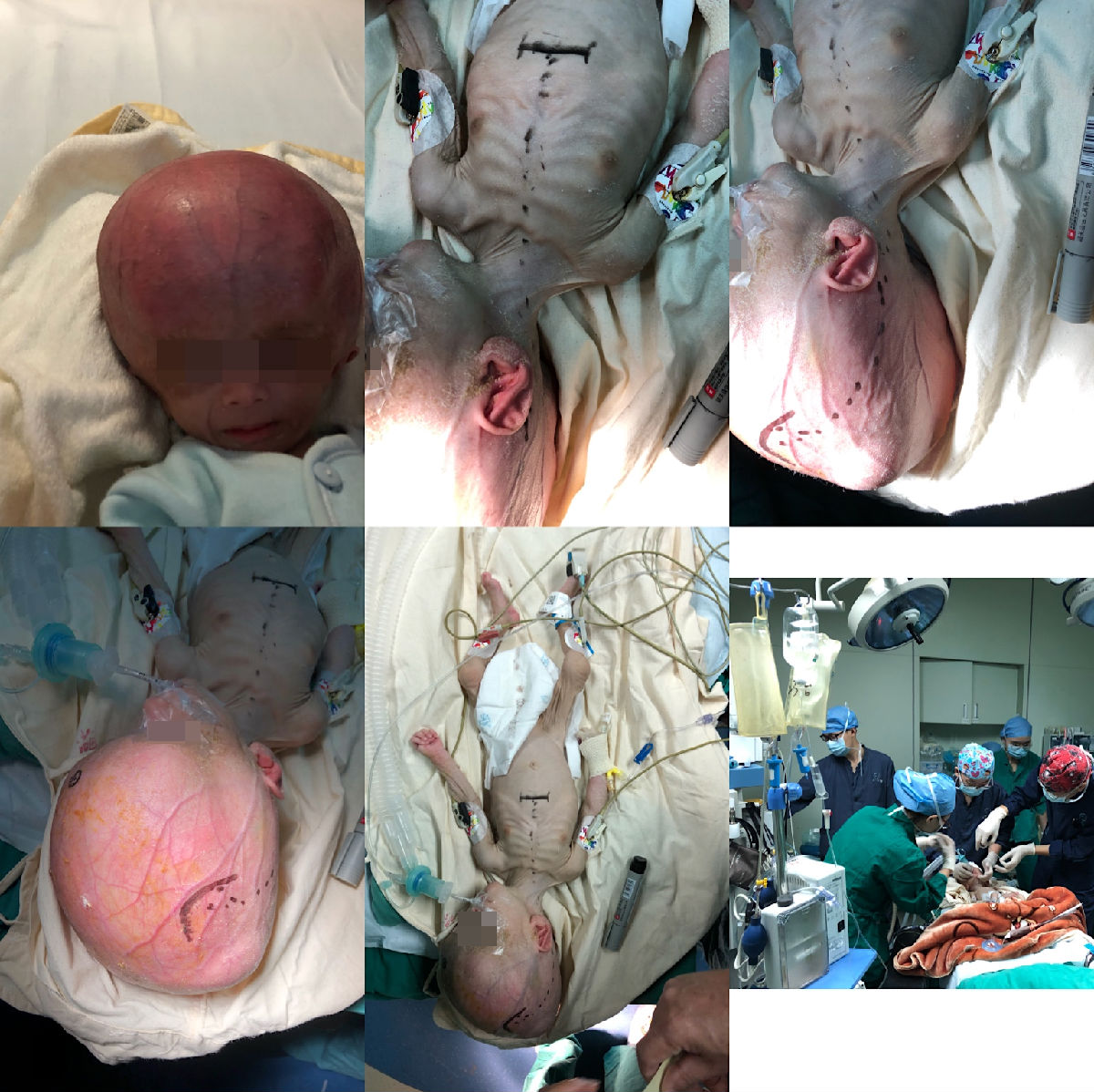 “大头大头”下雨不愁，却愁坏了这家子 —— 神外医护齐上阵，圆“大头”娃娃健康梦