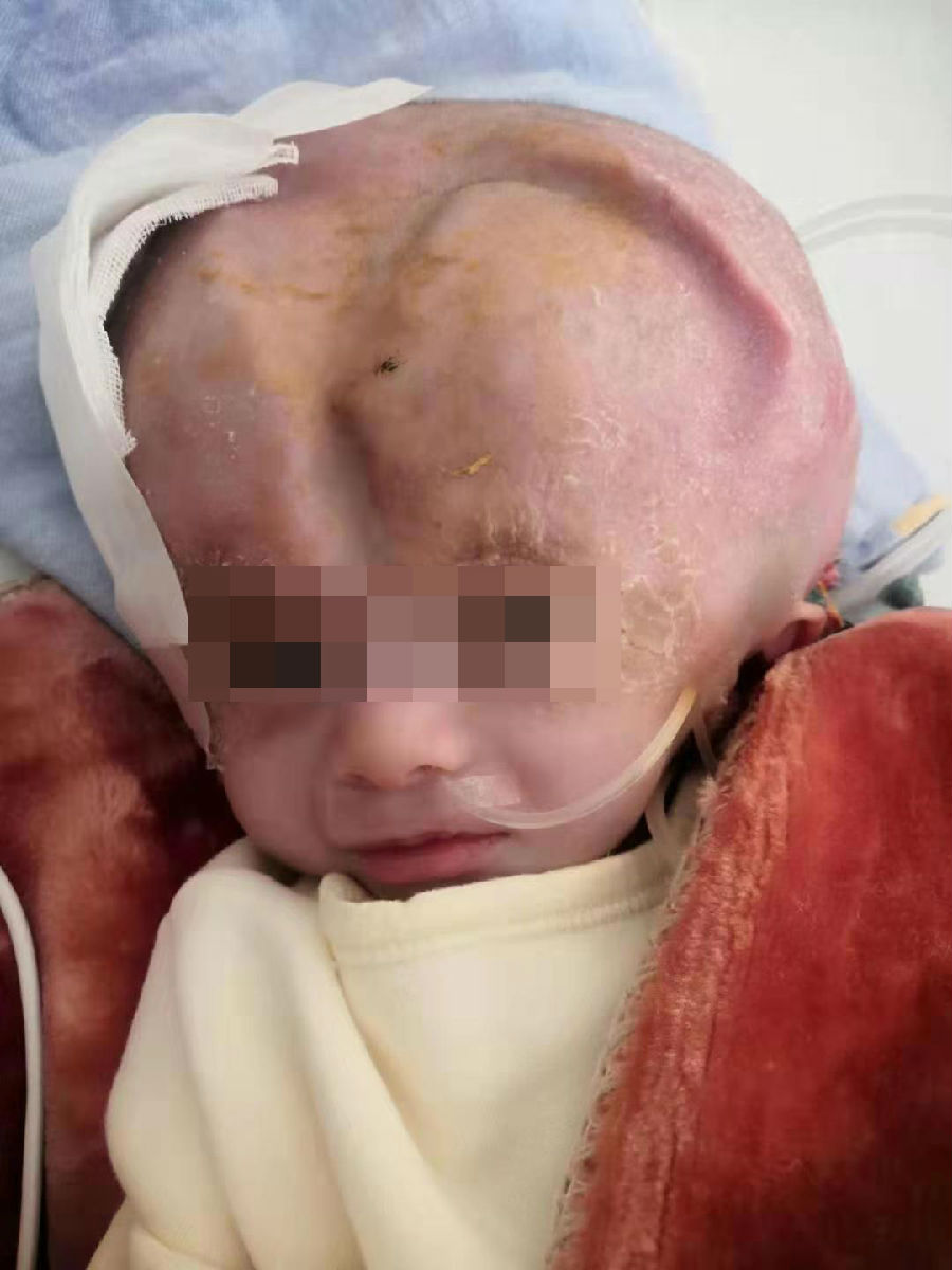 “大头大头”下雨不愁，却愁坏了这家子 —— 神外医护齐上阵，圆“大头”娃娃健康梦