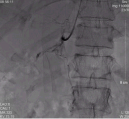 我院成功诊断并治愈1例高龄原发性醛固酮增多症患者