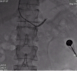 我院成功诊断并治愈1例高龄原发性醛固酮增多症患者