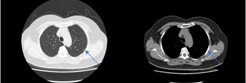 免插管免禁食！我院胸外科肺结节切除手术进入微创新时代