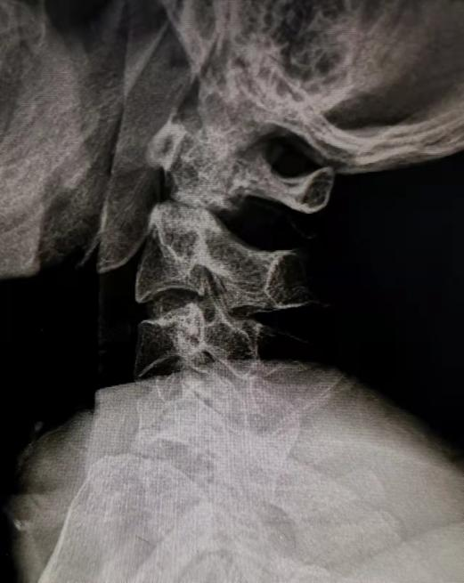 福建医科大学附一泉港总医院完成泉港地区首例寰枢椎骨折后路切开复位内固定联合颈前路多节段颈椎手术