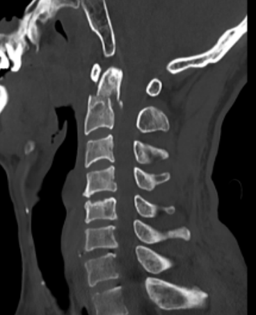 福建医科大学附一泉港总医院完成泉港地区首例寰枢椎骨折后路切开复位内固定联合颈前路多节段颈椎手术