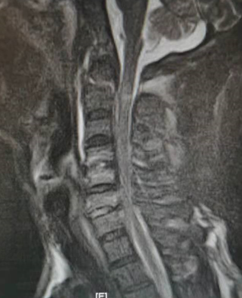 福建医科大学附一泉港总医院完成泉港地区首例寰枢椎骨折后路切开复位内固定联合颈前路多节段颈椎手术