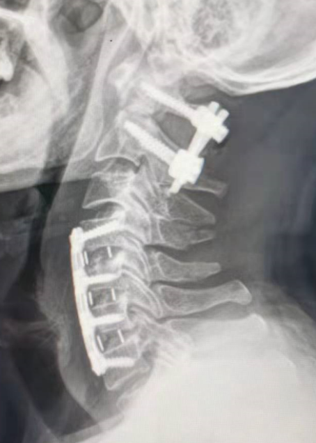 福建医科大学附一泉港总医院完成泉港地区首例寰枢椎骨折后路切开复位内固定联合颈前路多节段颈椎手术