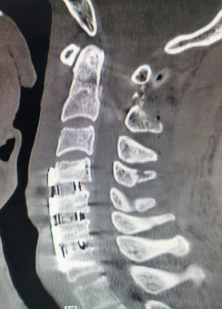 福建医科大学附一泉港总医院完成泉港地区首例寰枢椎骨折后路切开复位内固定联合颈前路多节段颈椎手术