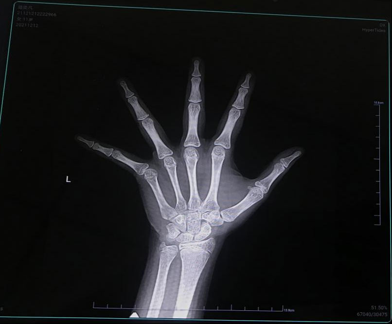 我院儿童生长发育专科门诊 免费为200多名孩子测骨龄