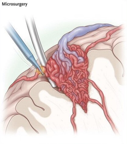 年轻人常见的脑出血原因-说说脑血管畸形