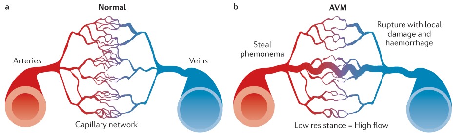 年轻人常见的脑出血原因-说说脑血管畸形